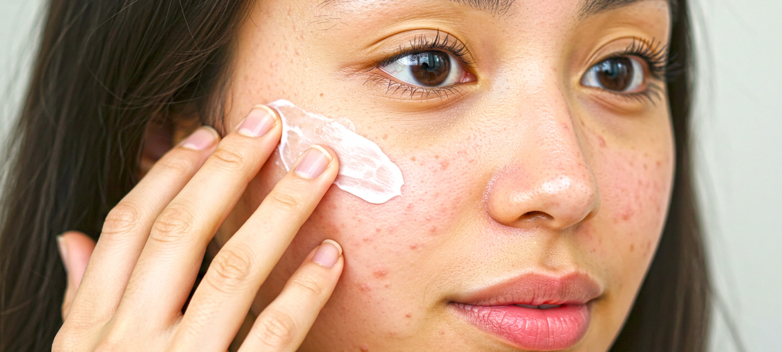 Adult acne: our beauty tips to deal with it