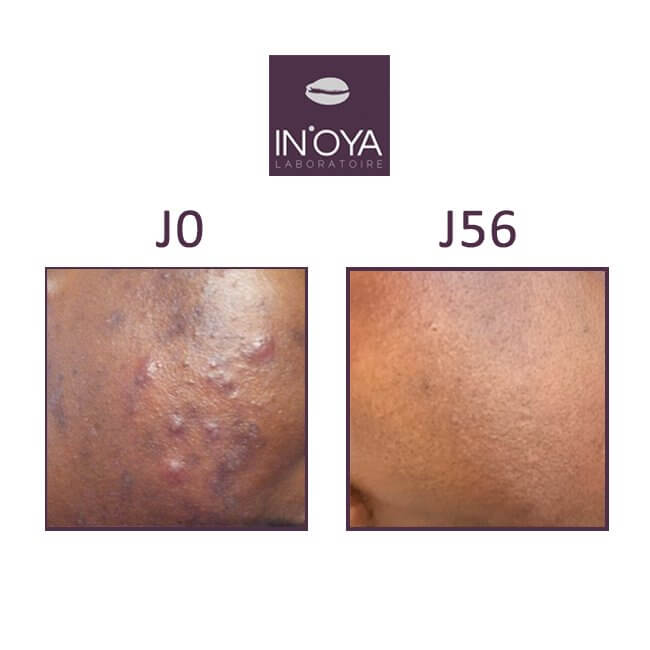 IN'OYA - My anti-imperfection treatment - 30mL - In'oya - Ethni Beauty Market
